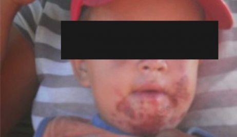 Campo Hardy: Denuncian secuelas de la fumigación de algodón en niños 