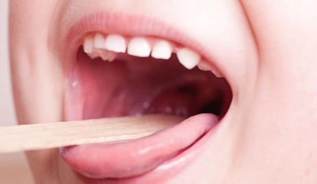 El Ministerio de Salud brindó información sobre casos de sepsis en niños por streptococo pyogenes.