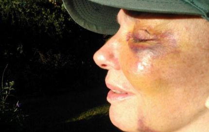 La foto del rostro golpeado de Graciela Borges, tras ser atropellada