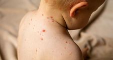 Confirman nuevos casos de sarampión en niñas no vacunadas